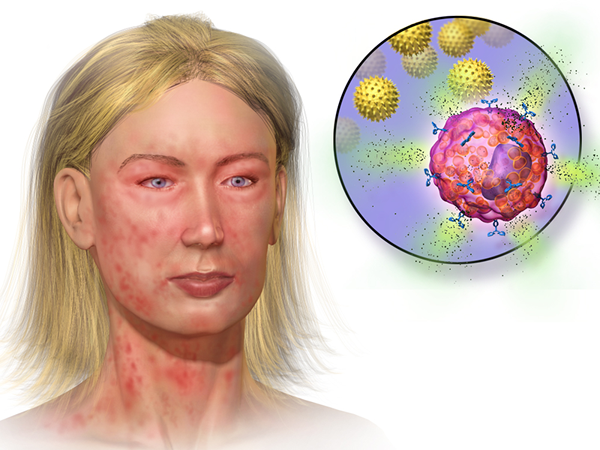 ¿Cuál es la diferencia entre la mastocitosis y los MCA?