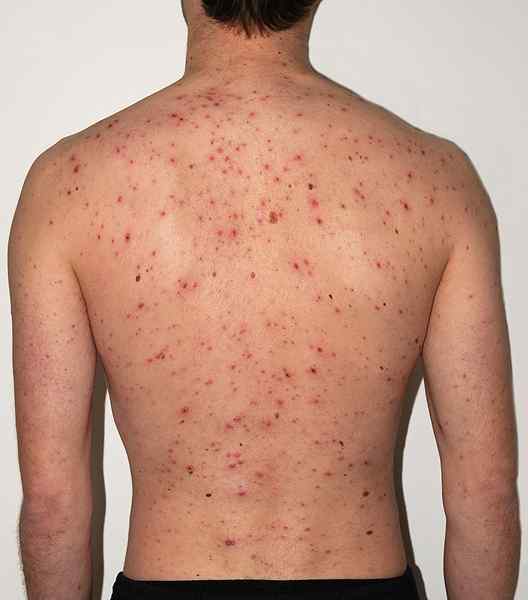 ¿Cuál es la diferencia entre monkeoypox y varicela?