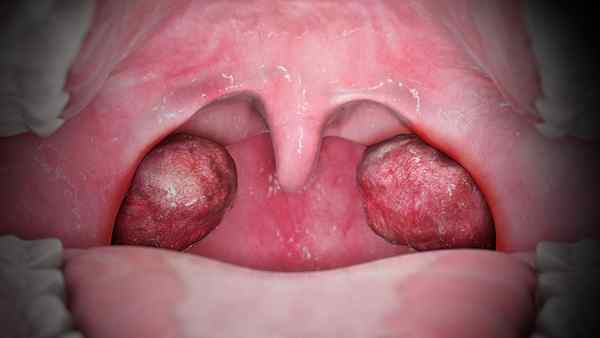 Apakah perbezaan antara mono dan tonsillitis