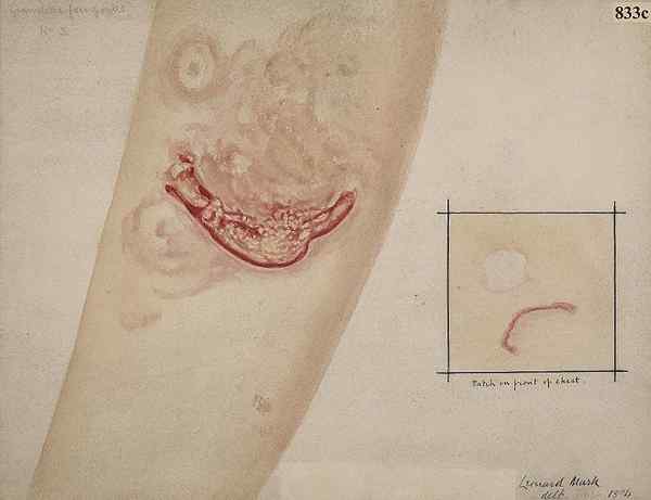¿Cuál es la diferencia entre la micosis fungoides y el síndrome szary?