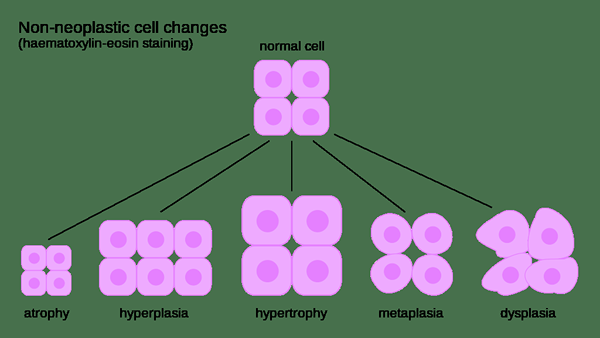 Quelle est la différence entre les polypes néoplasiques et non néoplasiques