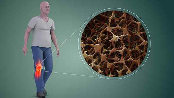 Was ist der Unterschied zwischen Osteogenese Imperfecta und Osteoporose