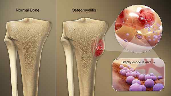 Apakah perbezaan antara osteomyelitis dan osteomalacia