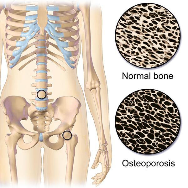 ¿Cuál es la diferencia entre la osteoporosis y la escoliosis?