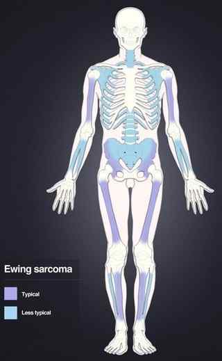 Quelle est la différence entre l'ostéosarcome et le sarcome d'Ewing