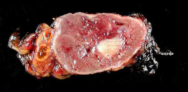 Apa perbedaan antara paraganglioma dan pheochromocytoma