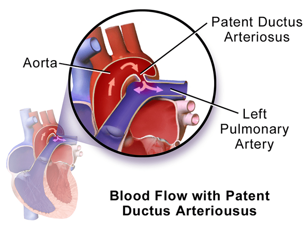 Apa perbedaan antara paten ductus arteriosus dan truncus arteriosus