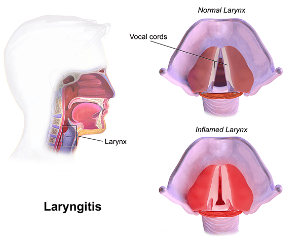 Was ist der Unterschied zwischen Pharyngitis und Laryngitis