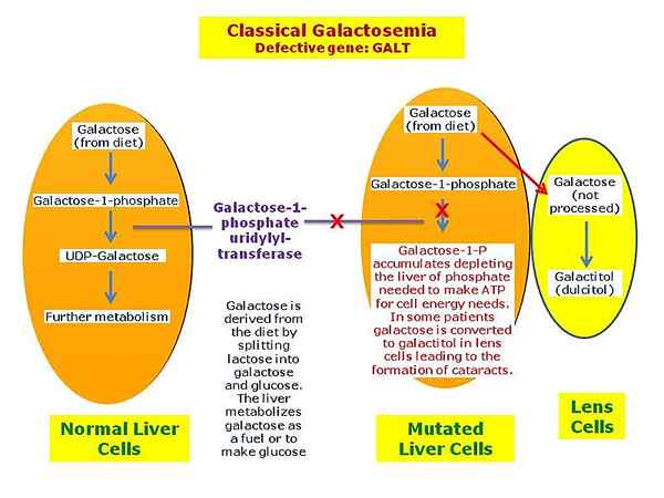 ¿Cuál es la diferencia entre fenilcetonuria y galactosemia?