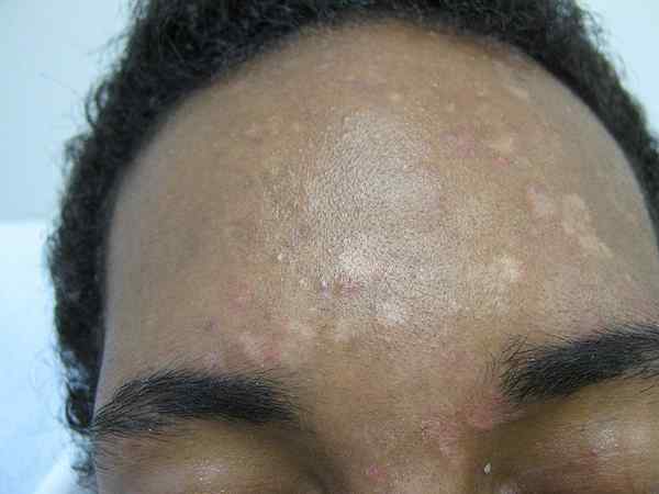 Apa perbedaan antara Pityriasis versicolor dan vitiligo