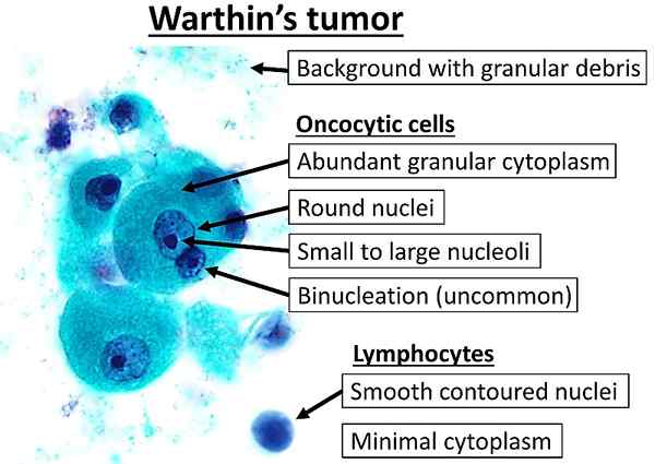Quelle est la différence entre l'adénome pléomorphe et la tumeur de la Warthin