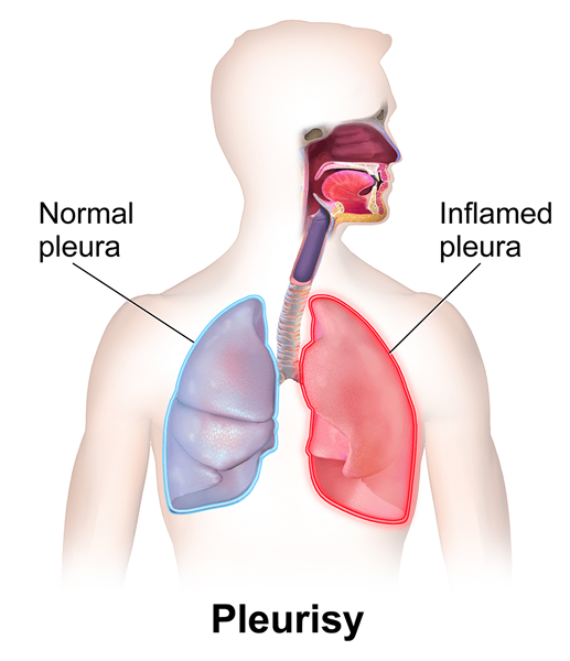 Was ist der Unterschied zwischen Pleuraergie und Pleuritis