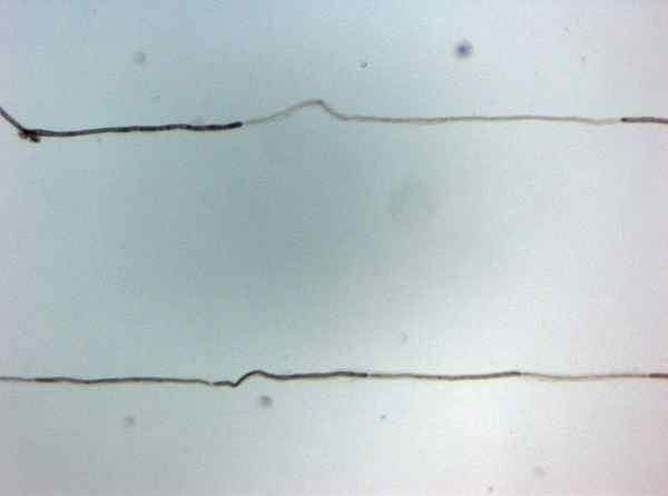 Apakah perbezaan antara polyneuropathy dan neuropati periferal