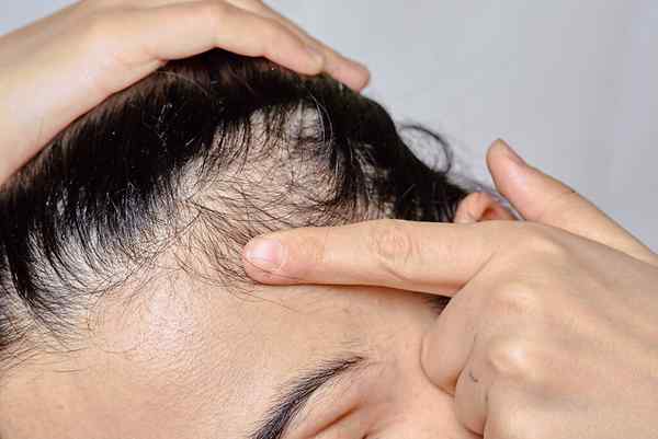 ¿Cuál es la diferencia entre la psoriasis del cuero cabelludo y la caspa?