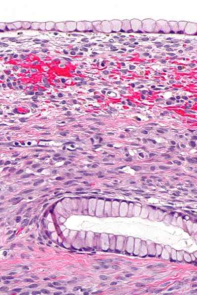 Apakah perbezaan antara cystadenoma serous dan mucinous ovari