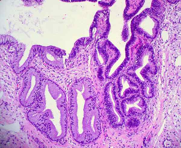 ¿Cuál es la diferencia entre el carcinoma de células escamosas y el cuello uterino de adenocarcinoma?