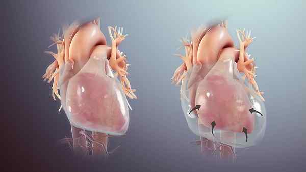 ¿Cuál es la diferencia entre el neumotórax de la tensión y la tamponada cardíaca?