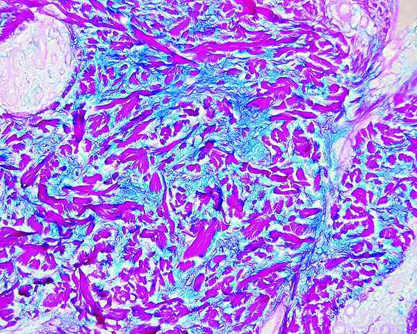 Quelle est la différence entre le follicule thyroïdien et les colloïdes