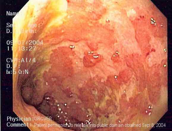 ¿Cuál es la diferencia entre la colitis ulcerosa y la enfermedad de Crohn?