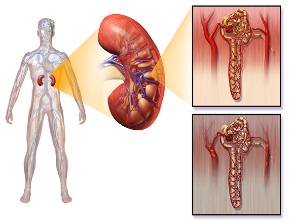 Apa perbedaan antara uremia dan azotemia