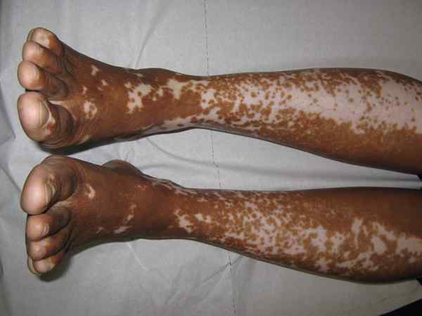 ¿Cuál es la diferencia entre vitiligo y psoriasis?