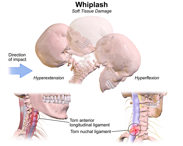 Apa perbedaan antara whiplash dan gegar otak