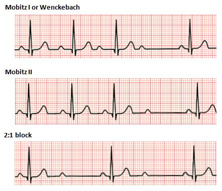 Unterschied zwischen 1. und 3. Grades Herzblock