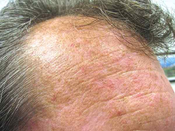 Perbedaan antara keratosis aktinik dan keratosis seboro