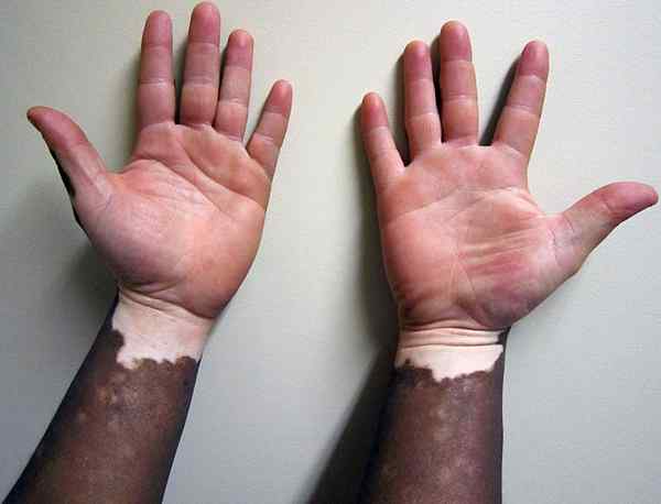 Perbezaan antara albinisme dan vitiligo