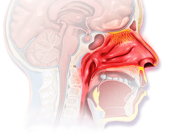 Perbezaan antara rhinitis alergi dan bukan alergi