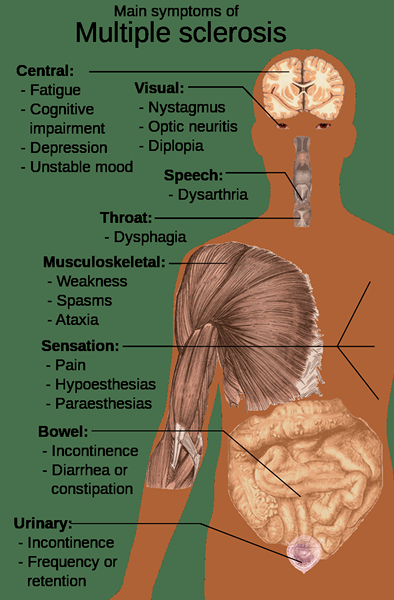 Perbedaan antara ALS dan MS (Multiple Sclerosis)