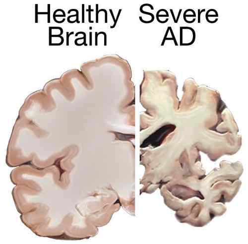 Différence entre les Alzheimers et la démence