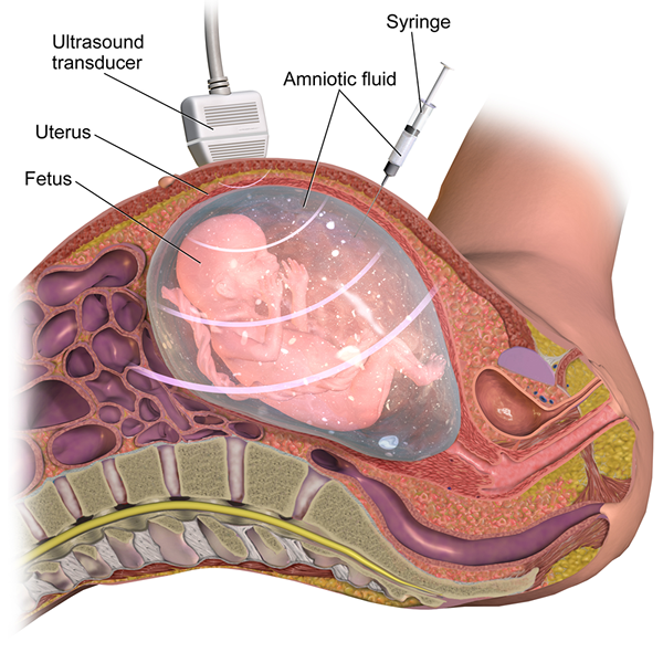 Perbezaan antara amniosentesis dan pensampelan villus chorionic