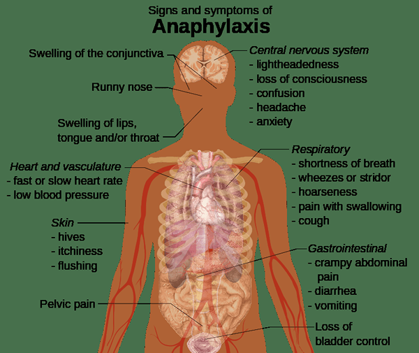 Diferencia entre anafilaxis y choque anafiláctico