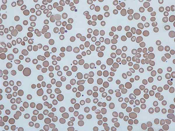 Perbedaan antara anisositosis dan poikilocytosis