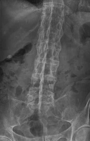 Différence entre la spondylarthrite ankylosante et la maladie dégénérative du disque