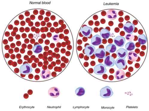 Diferencia entre anemia aplásica y leucemia