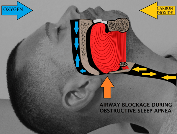 Diferencia entre apnea y disnea