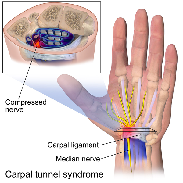 Différence entre l'arthrite et le syndrome du canal carpien