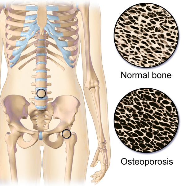 Perbedaan antara radang sendi dan osteoporosis