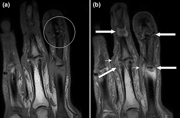 Unterschied zwischen Arthritis und Sehnenentzündung