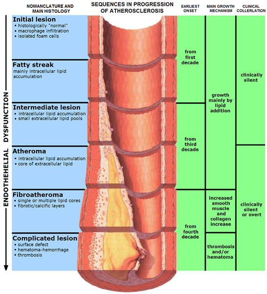 Diferencia entre ateroma y aterosclerosis