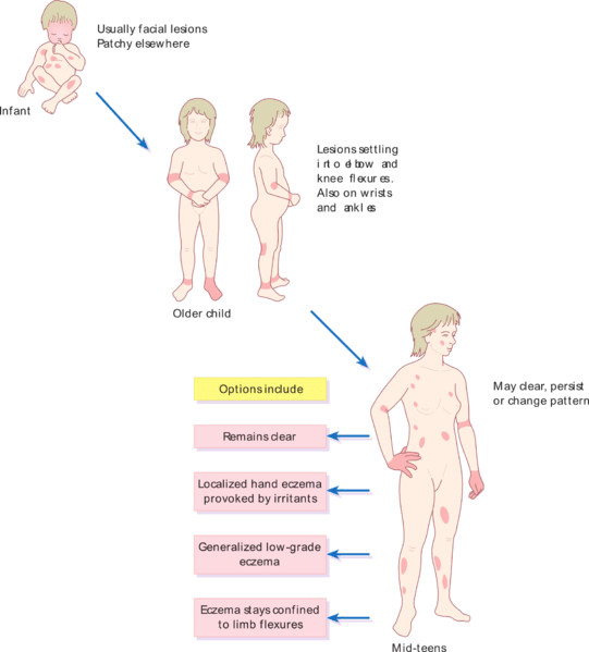 Diferencia entre la dermatitis atópica y el eccema