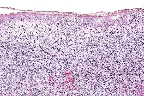 Différence entre les cellules B et le lymphome des cellules T