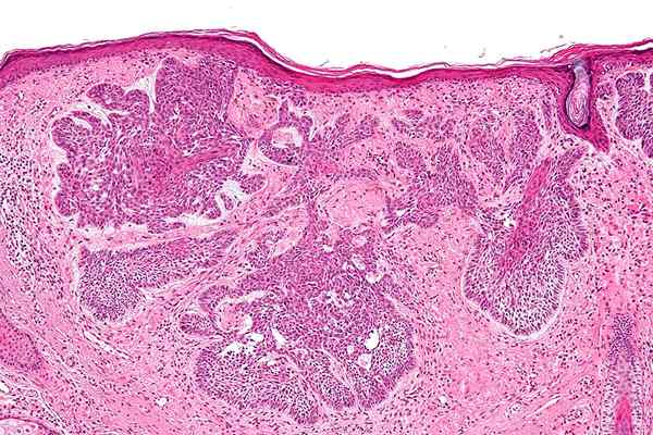 Différence entre le carcinome basal des cellules et le carcinome épidermoïde