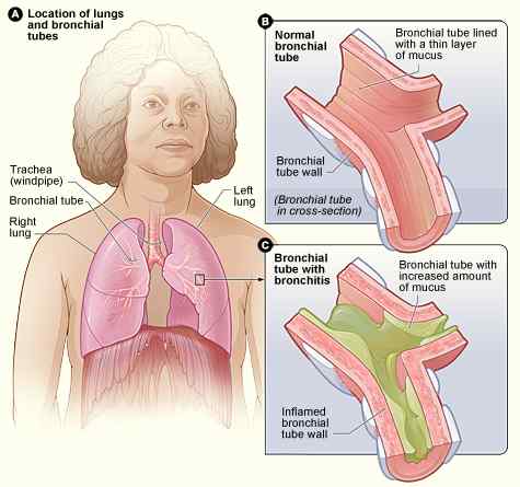 Diferencia entre la bronquitis y la tos ferina