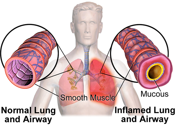 Différence entre bronchospasme et bronchoconstriction