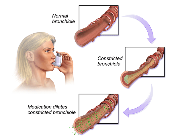 Différence entre les bronchospasmes et les laryngospasmes