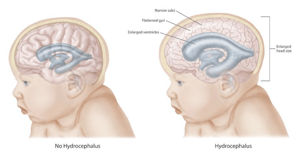 Différence entre œdème cérébral et hydrocéphalie