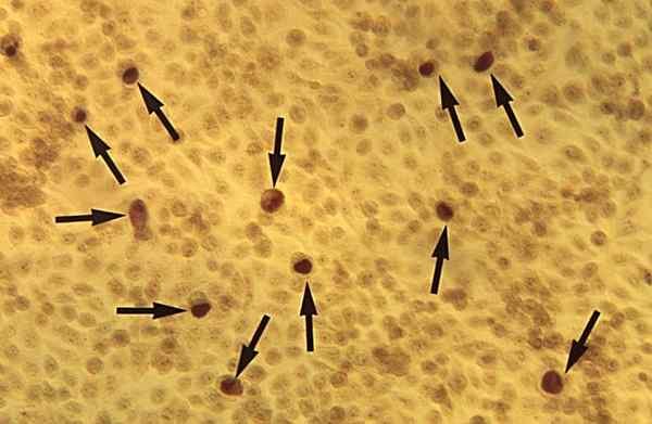 Différence entre la chlamydia et le muguet